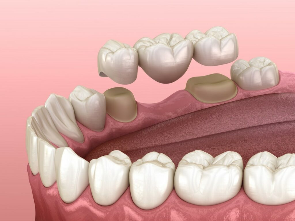 La prothèse dentaire